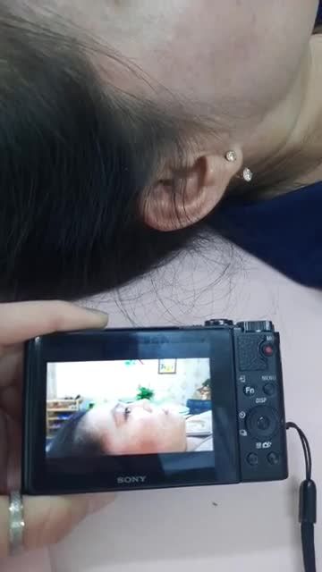 LÀM ĐẸP ĐÓN TẾT Giai đoạn chạy nước rút  Nâng mũi CẤU TRÚC 2 LỚP