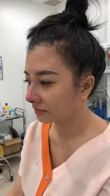 MŨI ÍT SƯNG BẦM SAU PHẪU THUẬT LÀ VÌ ĐÂU?