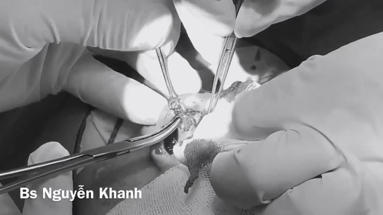 NÂNG MŨI CHỈ: CÓ PHẢI AI CŨNG ĐƯỢC LÀM?