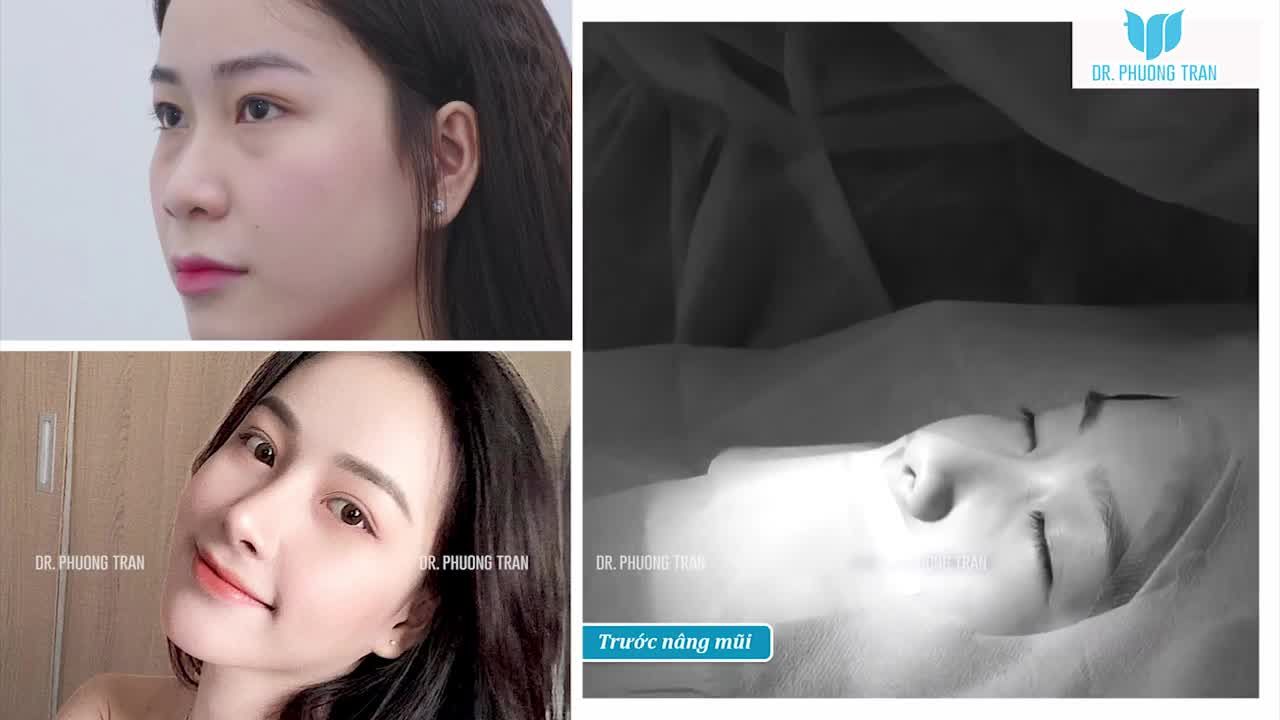 NÂNG MŨI MÀ "KHÔNG HỀ CÓ CẢM GIÁC ĐAU", CÁC BẠN CÓ TIN KHÔNG?