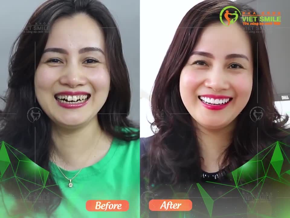 Review dán sứ veneer đẹp Khách hàng nói gì về VIET SMILE