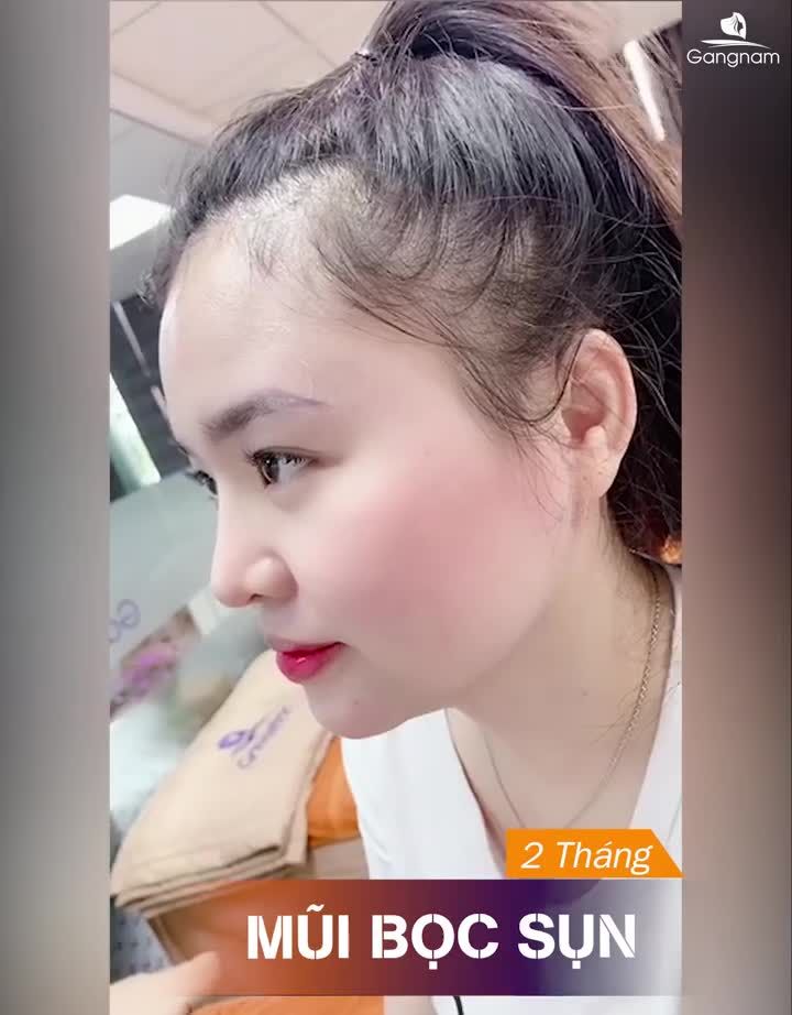 SỤN TỰ THÂN TRONG NÂNG MŨI LÀ GÌ?