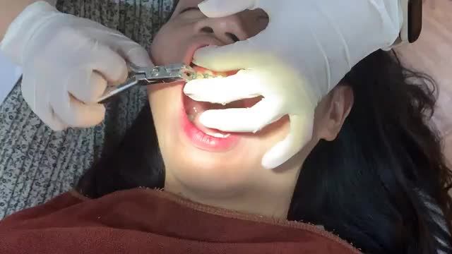 THÁO MẮC CÀI cho bệnh nhân răng KHẤP KHỂNH
