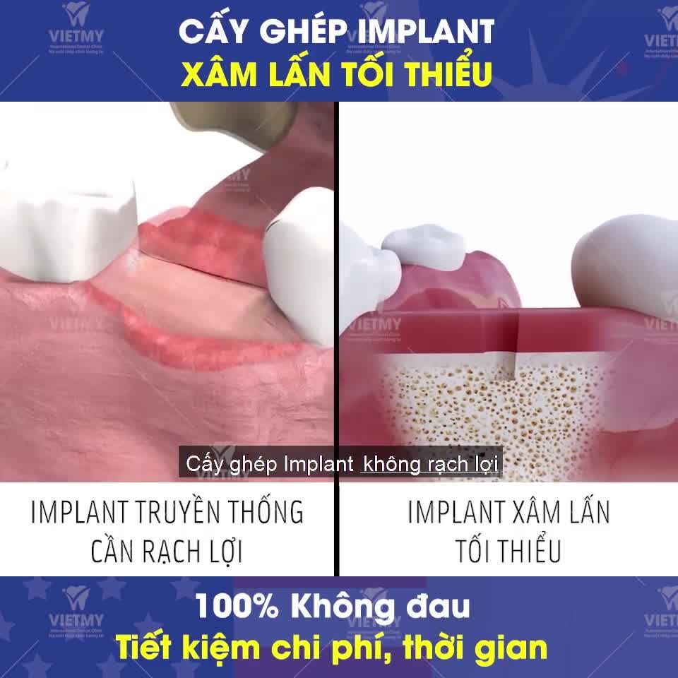Trồng răng Implant XÂM LẤN TỐI THIỂU Xu hướng mới trong Nha khoa hiện đại