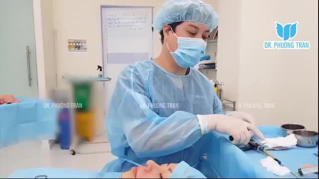 CẬN CẢNH QUY TRÌNH XÓA RÃNH MŨI MÁ ĐẨY CẰM BẰNG MỠ TỰ THÂN