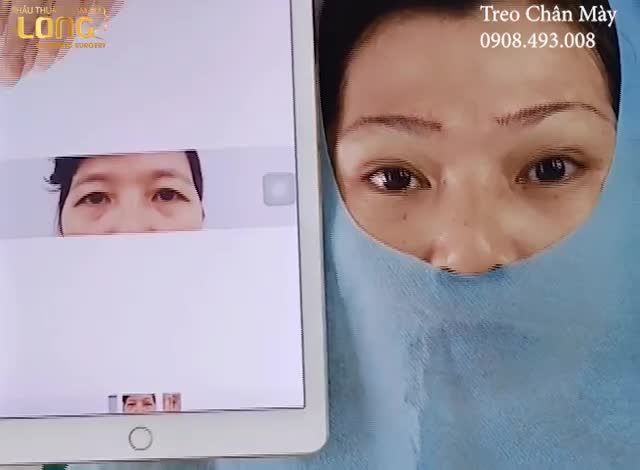 Case treo chân mày vừa mới thực hiện