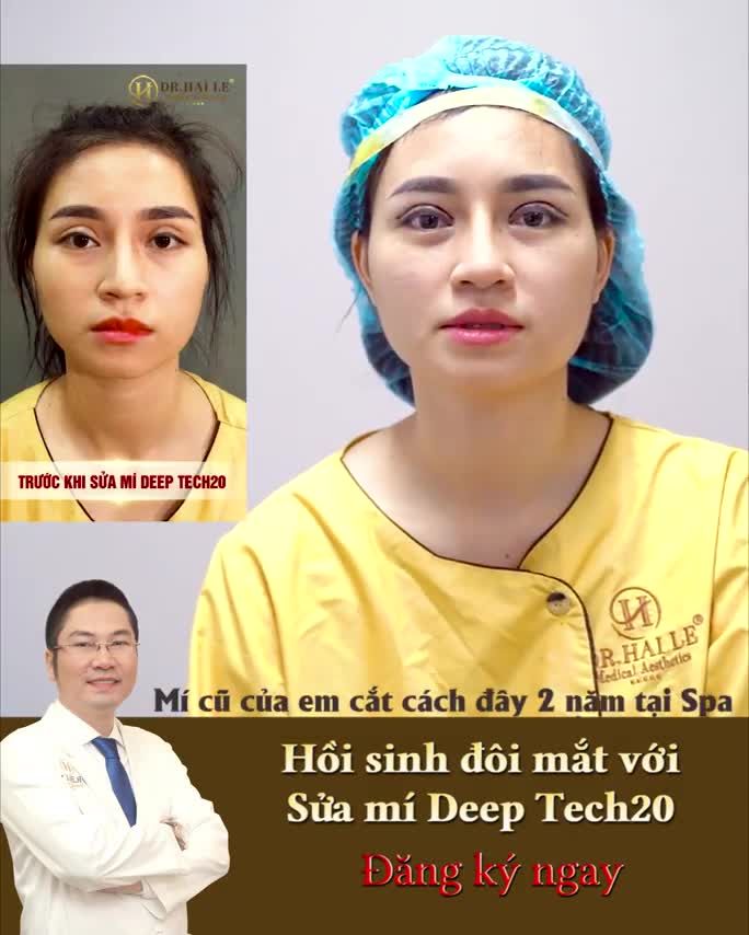 Khách hàng Hồng Nhung chia sẻ về lần 1 cách đây 2 năm cắt mí hỏng tại cơ sở khác và chỉ khi tới Dr.Hải Lê mới được sửa "thành công" nhờ Deep Tech20.