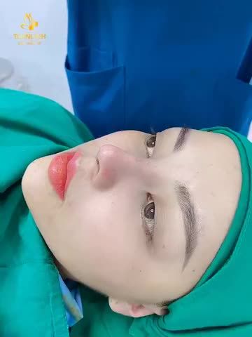 Khách hàng thực hiện NÂNG MŨI CẤU TRÚC DÁNG MŨI ANGEL LINE TỰ NHIÊN, HÀI HÒA