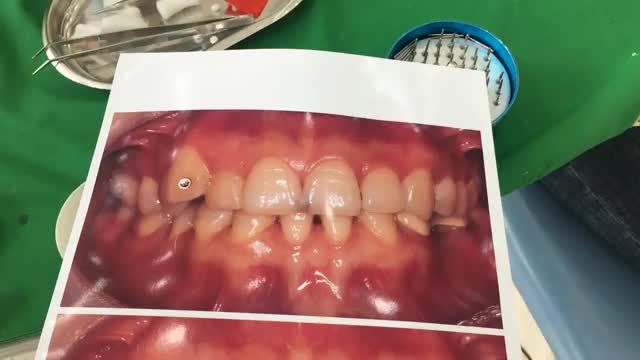 Ca gắn răng sứ thẩm mỹ điều trị sâu kẽ cho khách hàng.