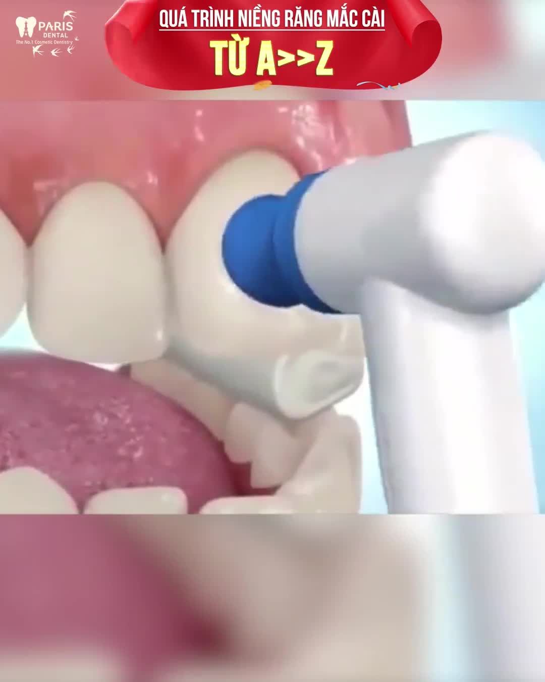 Hô Thưa Móm Khấp khểnh Click xem sự thay đổi khi niềng răng