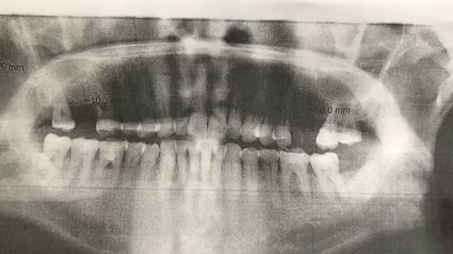ca cấy chân răng nhân tạo Implant R26