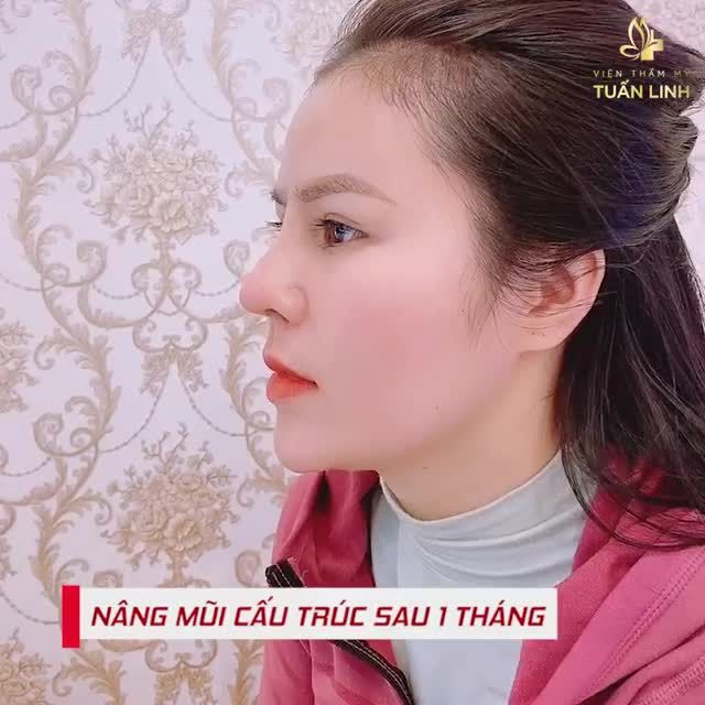 CẬN CẢNH DÁNG MŨI CẤU TRÚC SAU 1 THÁNG NÂNG MŨI TAI TMV TUẤN LINH