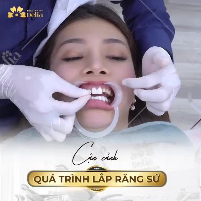 DÁN SỨ VENEER KHÔNG MÀI KHÔNG ĐAU BẢO HÀNH TRỌN ĐỜI