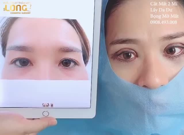 Kết quả case cắt mí, loại bỏ bọng mỡ của khách hàng vừa thực hiện