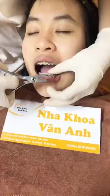 THÁO MẮC CÀI NIỀNG RĂNG CHO BỆNH NHÂN NỮ RĂNG THƯA CẮN CHÉO
