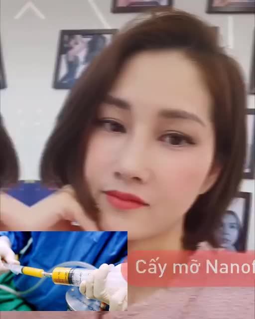 CẤY MỠ MẶT NANOFAT 45 phút xóa hốc hác