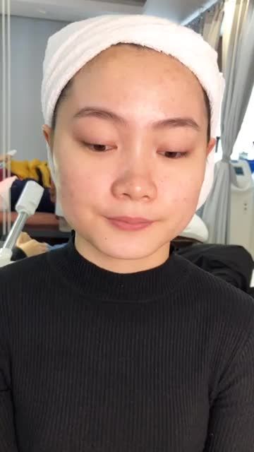 Da sạch mụn , trắng sáng sau 6 buổi trị mụn De-acne