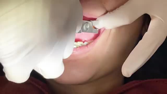 BUNG LỤA CHO KHÁCH HÀNG CHU HỒNG THẮM RĂNG HÔ KHẤP KHỂNH