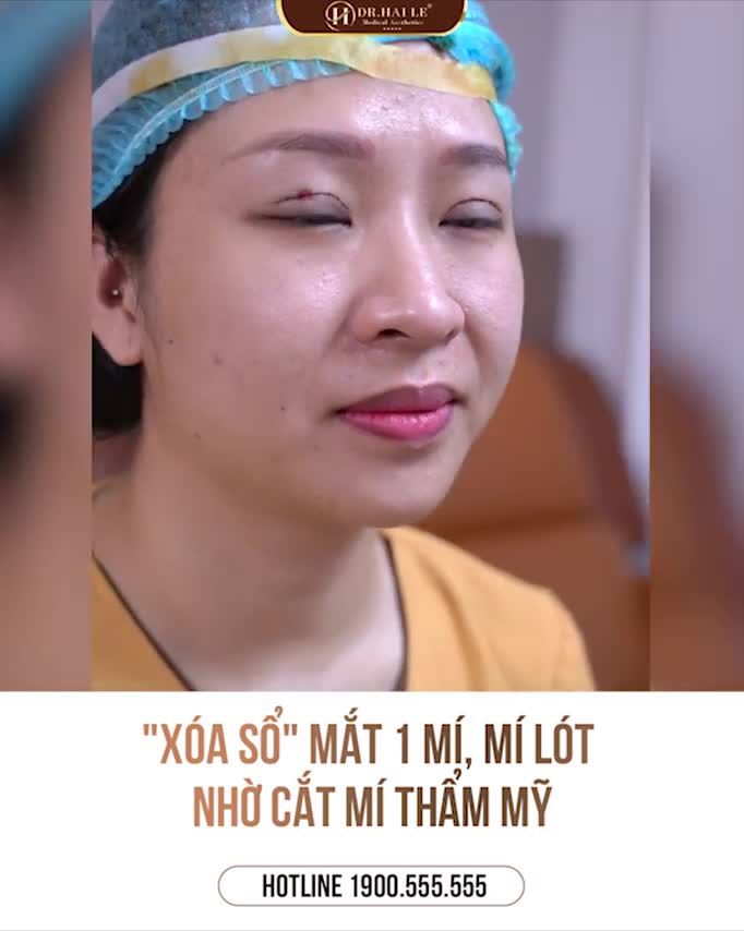 Cắt mí xong cứ ngỡ 2 người khác nhau luôn í.