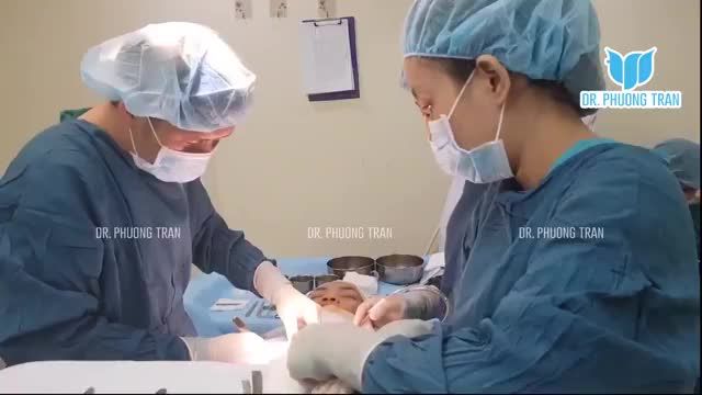 NÂNG MŨI CẤU TRÚC SỤN SƯỜN TOÀN PHẦN KẾT HỢP GHÉP SỤN XÓA RÃNH MŨI MÁ