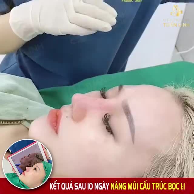 TRỜI ƠI TIN ĐƯỢC KHÔNG? NÂNG MŨI CẤU TRÚC SAU 10 NGÀY ĐÃ LÊN DÁNG THẾ NÀY SAO???