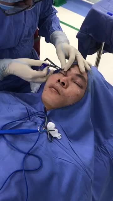 Cắt mí trên plasma Cải thiện ngay đôi mắt sụp cho khách hàng