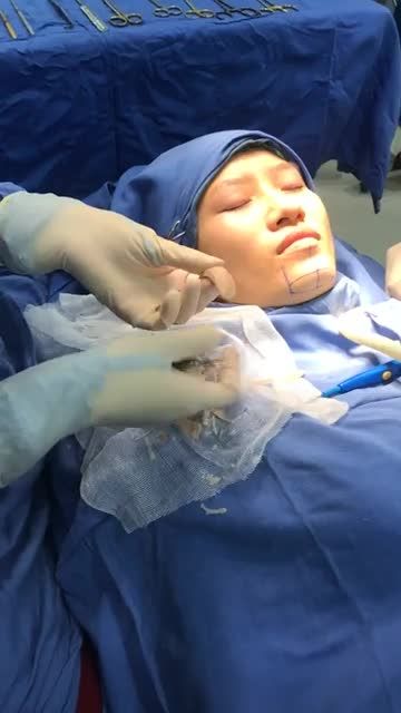 Giải pháp cho Cằm lẹm, Cằm ngắn và Cằm không cân đối Đến với Kangnam ngay cùng dịch vụ Độn Cằm không sưng không đau