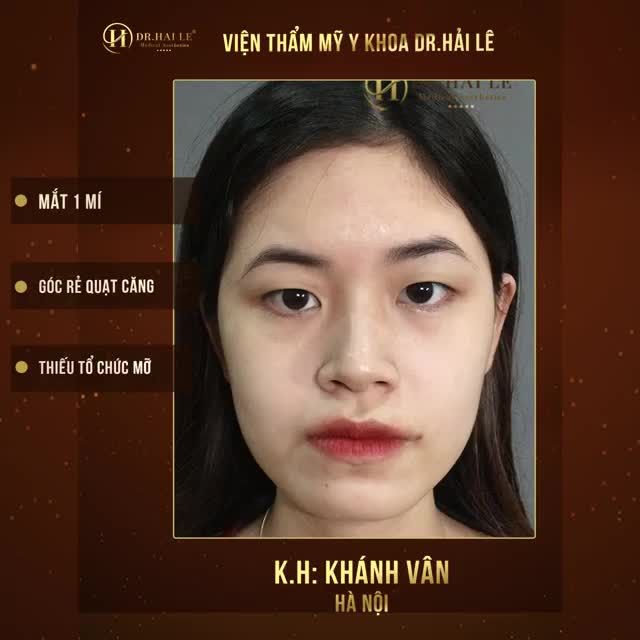 Khi bạn sở hữu mắt 1 mí bẩm sinh....Và quyết định tìm tới Cắt mí thẩm mỹ 10 người gặp thì 10 người khen.