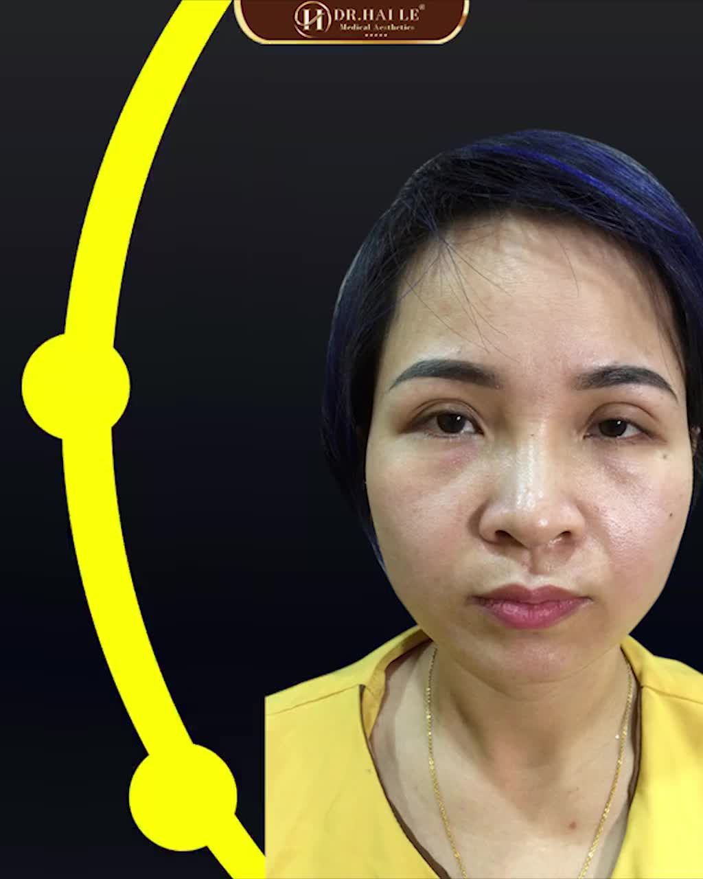 CẢNH BÁO “VỠ MỘNG” VỀ QUAN NIỆM CẮT MÍ QUÁ TO ĐỂ LÂU BỊ SỤP LẠI CỦA NHIỀU CHỊ EM!