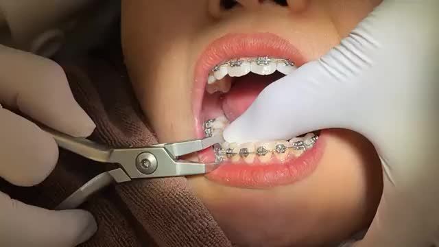 BUNG LỤA CHO KHÁCH HÀNG CHU HỒNG THẮM RĂNG HÔ THƯA