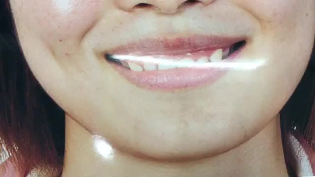 ca điều trị cười hở lợi, làm dài thân răng cho chị khách hàng tại Nha Khoa Thuỳ Anh.