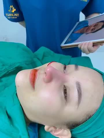 Case Nâng mũi sửa lại sau 90 phút phẫu thuật