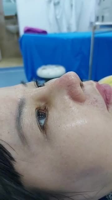 Khách Hàng tái khám Bs Kỳ Kết quả hoàn hảo sau 7 ngày