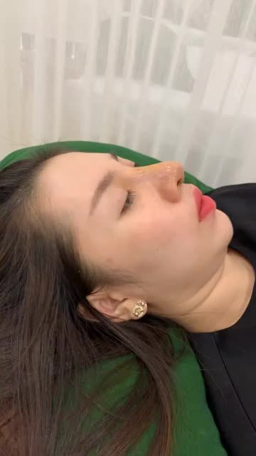 Mũi cấu trúc sửa lại sau 7 ngày tái khám