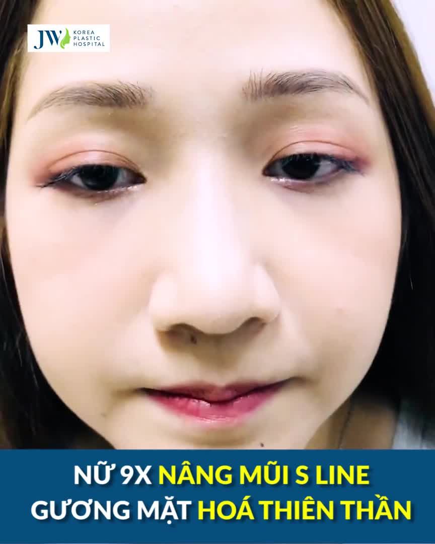 NÂNG MŨI NGAY LÚC NÀY TẾT CÓ NGAY DÁNG MŨI CỰC XINH