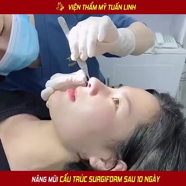 10 NGÀY HÔ BIẾN "MŨI THẤP TẸT" HÓA MŨI CAO SANG