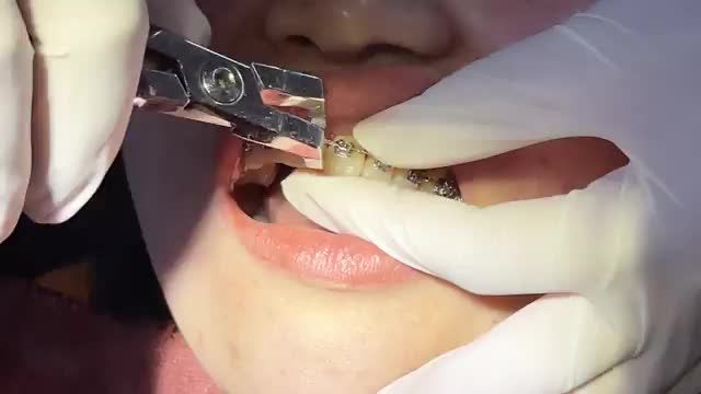 BUNG LỤA CHO KHÁCH HÀNG ĐỖ THỊ HƯƠNG RĂNG HÔ THƯA