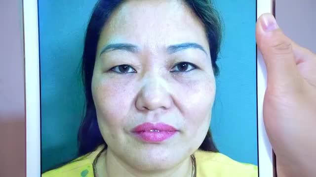 Nâng cung mày tiểu phẫu nhỏ hạnh phúc to chỉ 45 phút mang đến vẻ đẹp rạng rở trẻ trung cho khách hàng