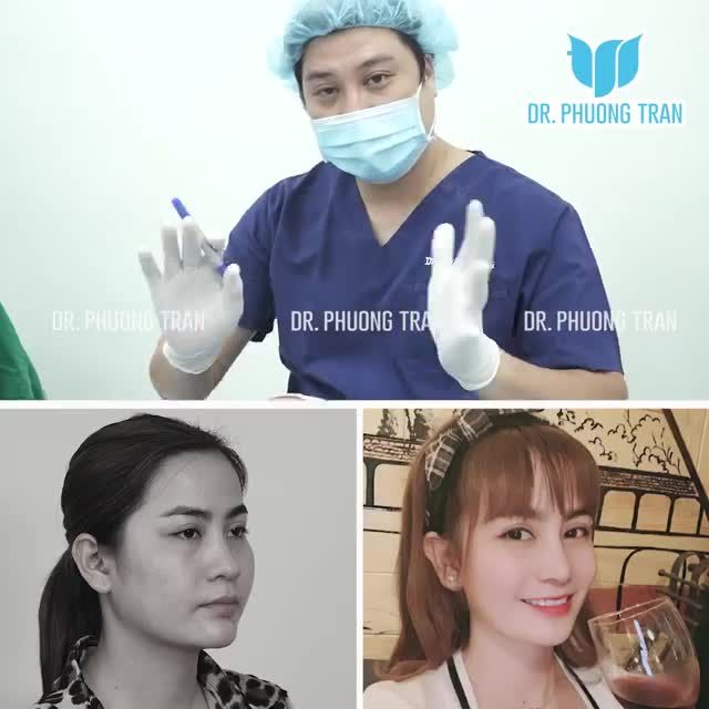 NÂNG MŨI CẤU TRÚC SURGIFORM: MŨI ĐẸP TỰ NHIÊN, HÀI HÒA VỚI GƯƠNG MẶT