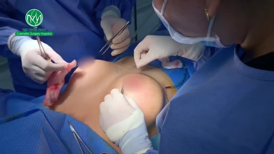 PHẪU THUẬT NÂNG NGỰC THAY ĐỔI VÓC DÁNG TẠO ĐƯỜNG NÉT CÂN ĐỐI HÀI HÒA TỰ NHIÊN