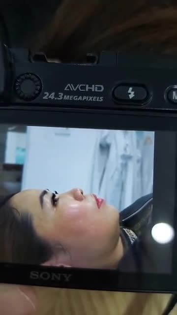 MŨI ĐẸP THANH TÚ BS KỲ Y DƯỢC Nâng mũi Bán cấu trúc Sụn tai 2 lớp Kết quả sau 10 ngày
