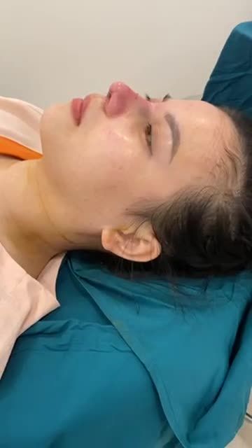 MŨI ÍT SƯNG BẦM TRONG CA PHẪU THUẬT LÀ VÌ ĐÂU?