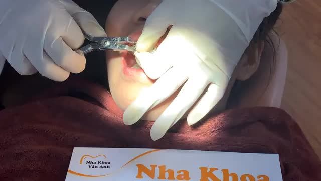 THÁO MẮC CÀI NIỀNG RĂNG CHO BỆNH NHÂN HÔ RĂNG, HÔ XƯƠNG