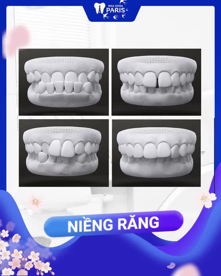 Răng Xấu Xí Đón Tết Có Như Ý ???