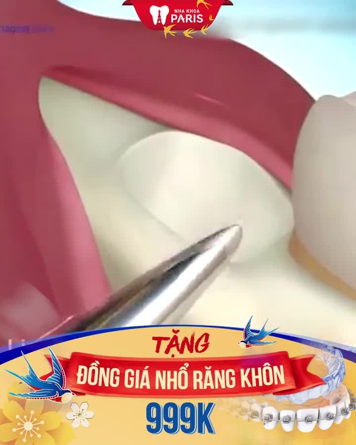 Muốn răng đều đẹp Ngại Tết cận kề