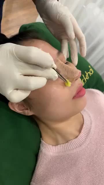 Mũi cấu trúc tái khám sau 10 ngày.