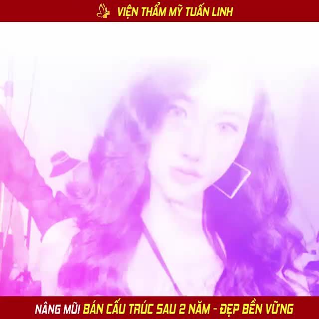 NÂNG MŨI BÁN CẤU TRÚC CÓ BỀN KHÔNG