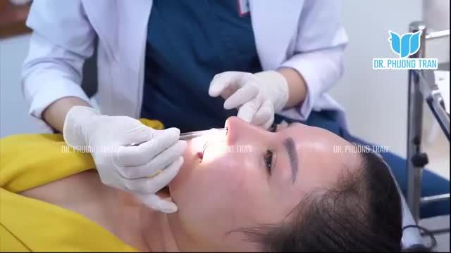 SỬA LẠI MŨI CAO THÔ, NHỌN ĐẦU MŨI VÀ CÁI KẾT SAU 14 NGÀY
