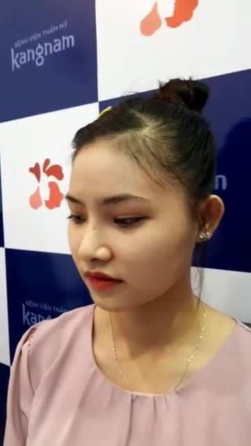 Nâng mũi dáng "bay" chỉ sau 10 ngày đẹp hoàn hảo