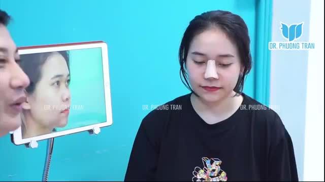 BÁC SĨ TRỰC TIẾP THĂM KHÁM VÀ THÁO NẸP CHO BẠN NỮ NÂNG MŨI SỤN SƯỜN TOÀN PHẦN